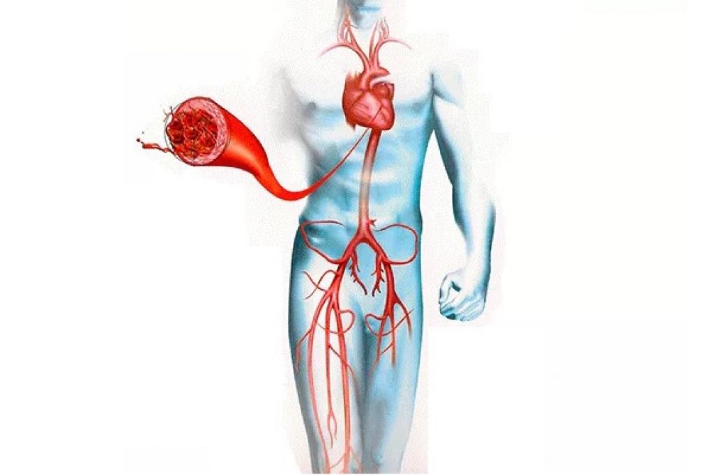 Артериальная тромбоэмболия. Тромбоз артериальных сосудов.